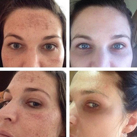 Before and after hyperpgimentation results of Caucasian Urban Skin Rx® customer