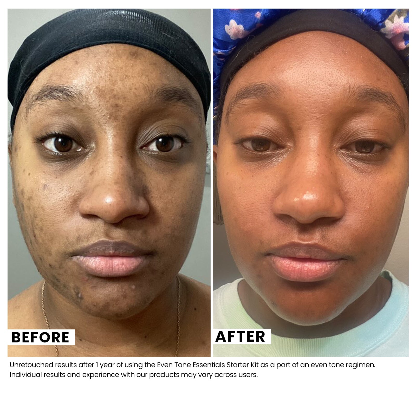 Woman's skin before and after using USRx Even Tone Essentials Starter Kit with visibly improved skin