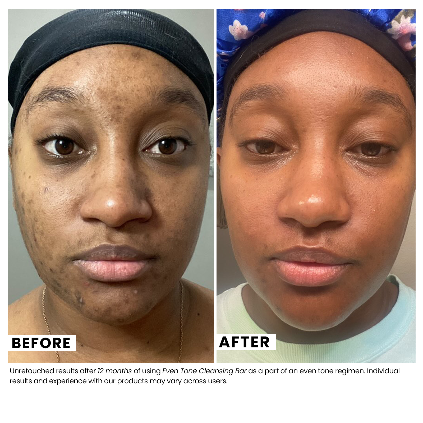 Woman's skin before and after using USRx Even Tone Cleansing bar with visbly improved skin