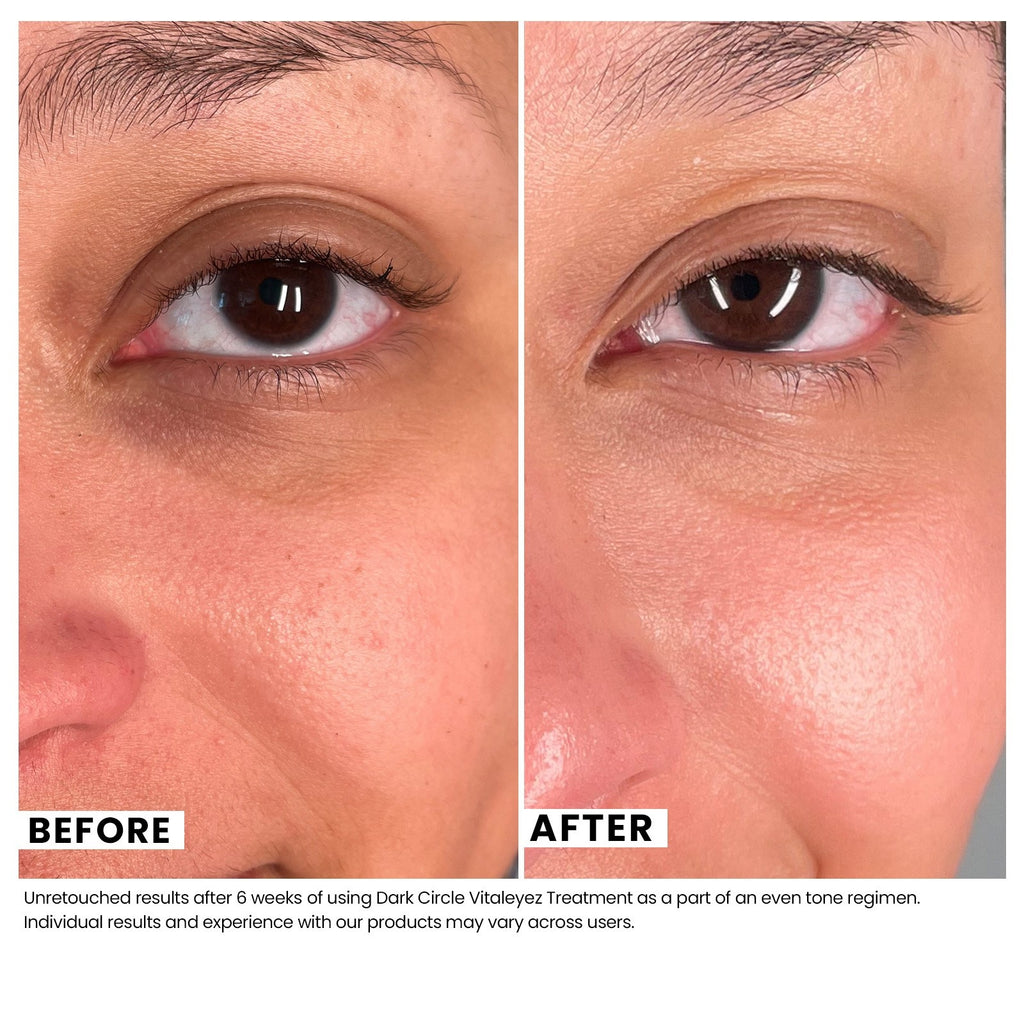 Dark Circle Vitaleyez Treatment - For Under-Eye Circles! | Urban