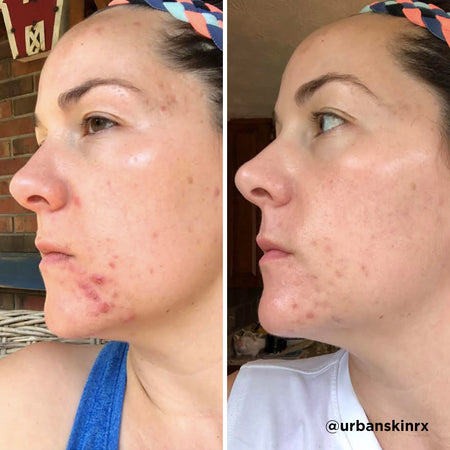 Before and after acne and hyperpgimentation results of Caucasian Urban Skin Rx® customer