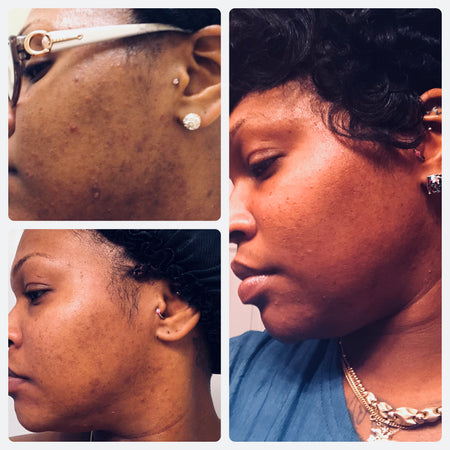 Before and after acne and hyperpgimentation results of African American Urban Skin Rx® customer with revitalized skin