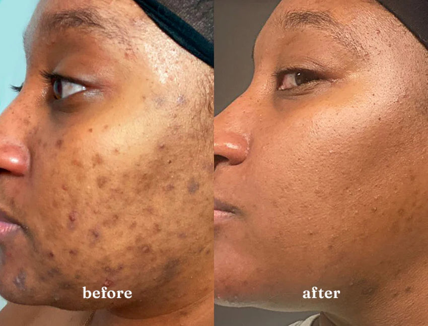 Woman's skin before and after using USRx Even Tone regimen