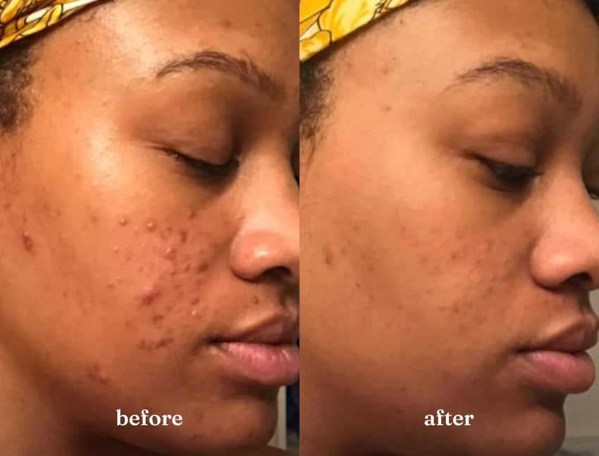 Woman's skin before and after using USRx Even Tone regimen