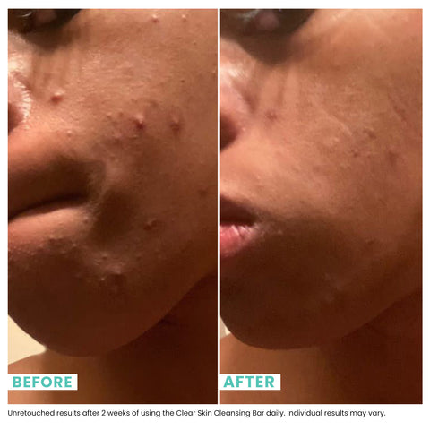 Woman's face before and after using USRX Clean Skin Cleansing Bar treatment for clarifying skin