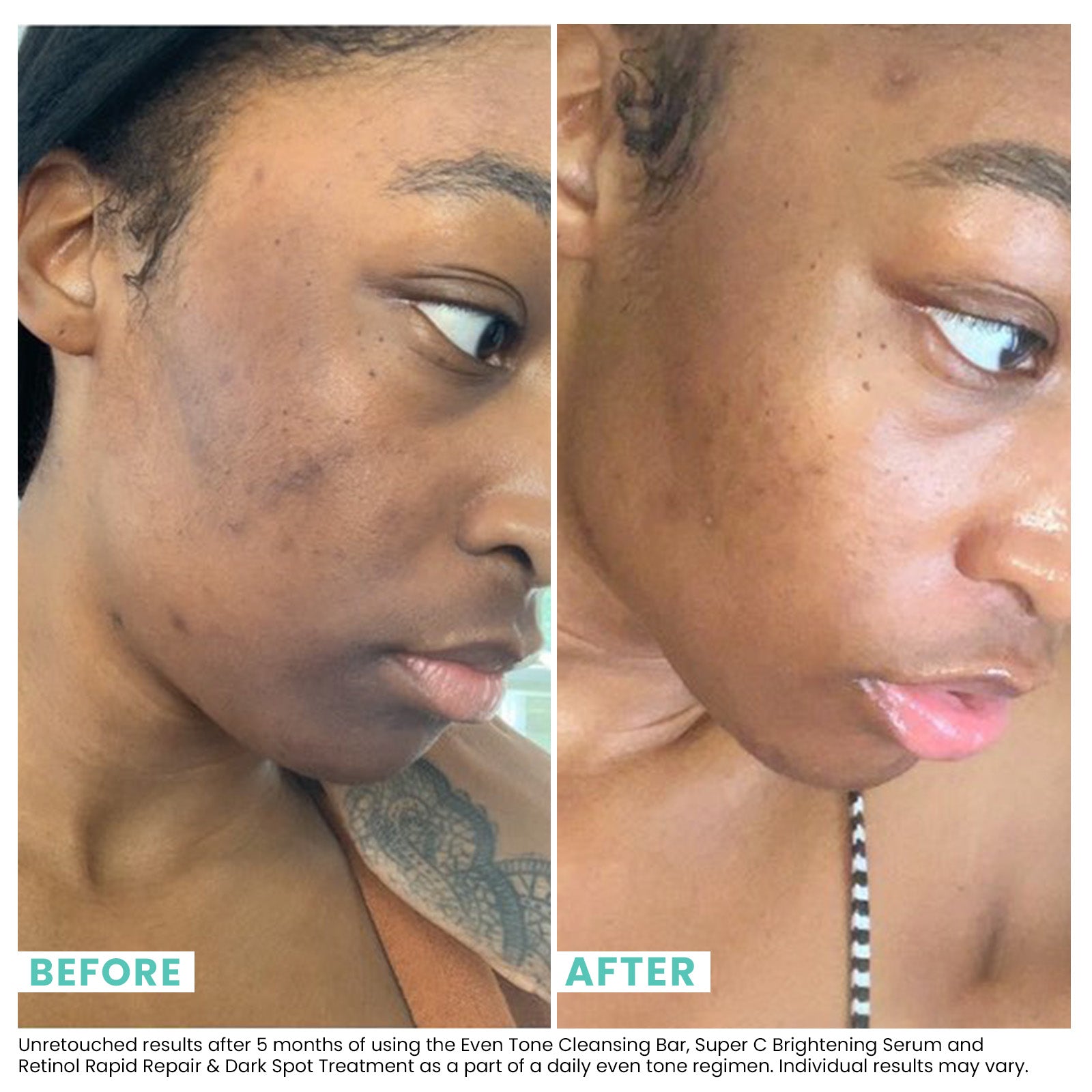 Woman's skin before and after using USRX Combination Skin Cleansing Bar