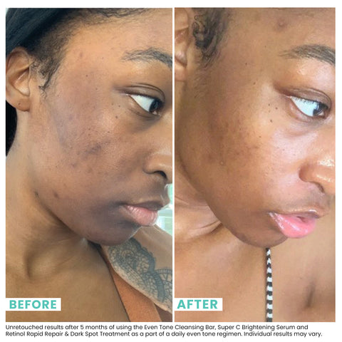 Woman's skin before and after using USRX Combination Skin Cleansing Bar