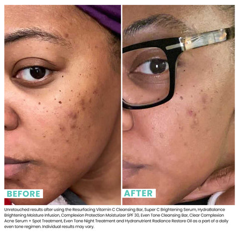 Woman's face before and after using Urban Skin RX Super C Brightening Serum