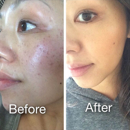 Before and after acne and hyperpgimentation results of ethnically diverse Urban Skin Rx® customer