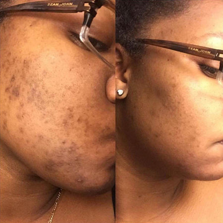 Before and after hyperpigmentation results of African American Urban Skin Rx® customer