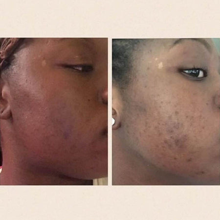 Before and after acne and hyperpgimentation results of African American Urban Skin Rx® customer with revitalized skin