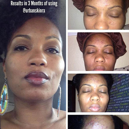 Before and after hyperpigmentation results of African American Urban Skin Rx® customer after 4 weeks of use