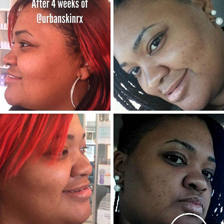 Before and after hyperpigmentation results of African American Urban Skin Rx® customer after 4 weeks of use