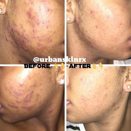 Before and after hyperpigmentation results of African American Urban Skin Rx® customer