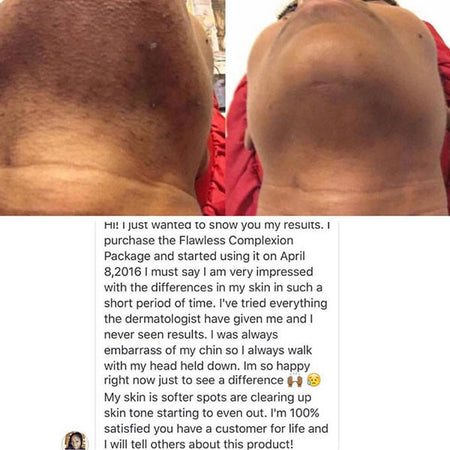 Before and after hyperpigmentation results of African American Urban Skin Rx® customer using the Flawless Complexion Package