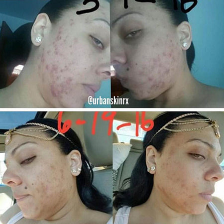 Before and after acne and hyperpgimentation results of Caucasian Urban Skin Rx® customer