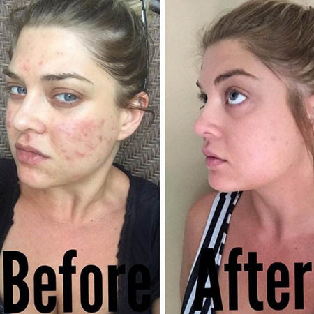Before and after acne and hyperpgimentation results of Caucasian Urban Skin Rx® customer