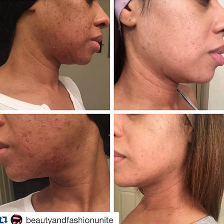 Before and after acne and hyperpgimentation results of African American Urban Skin Rx® customer