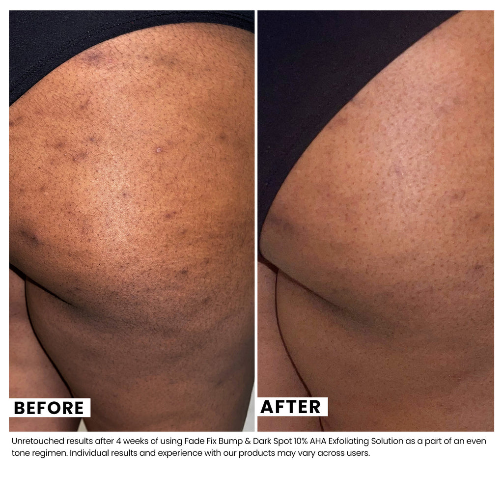 Woman's skin before and after using USRx fade fix solution