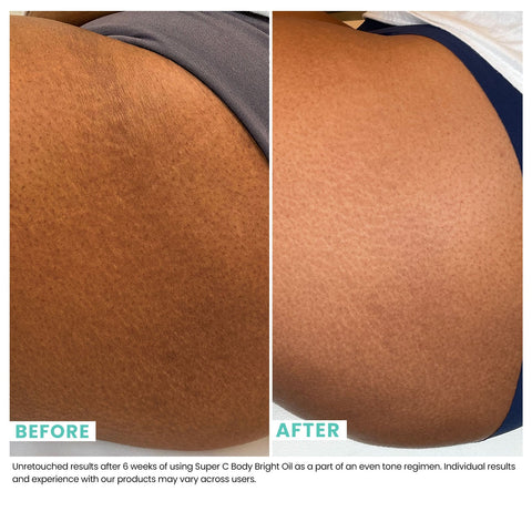 Woman's skin before and after using USRX Super C Body Bright Oil