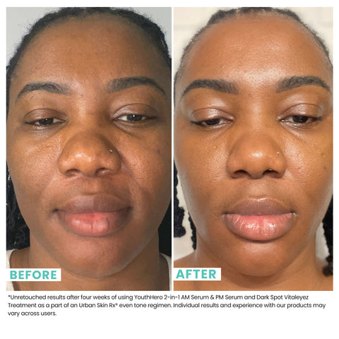Woman's skin before using Urban Skin RX YouthHero AM/PM Serums and after using it with visibly clearer skin