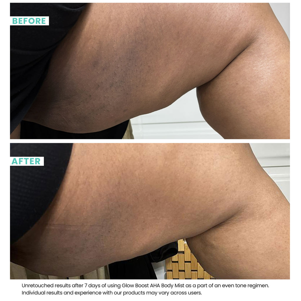 Woman's skin before and after using Bottles of USRX Glow Boost AHA Body Mist