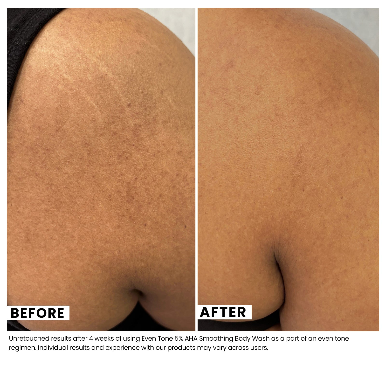 Woman's skin before and after using USRx Even Tone 5% AHA Smoothing Body Wash with visibly improved skin