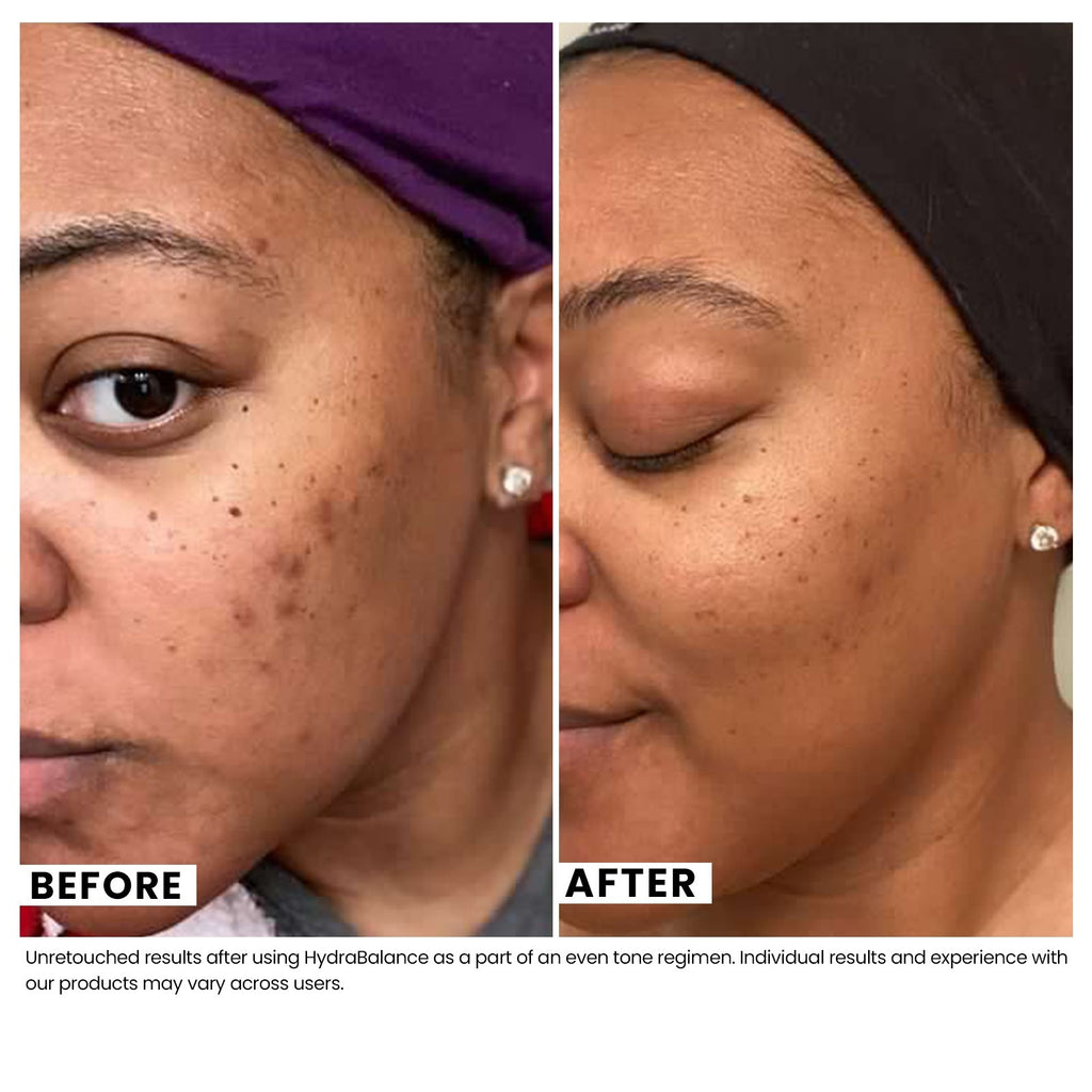 Woman's skin before and after using USRx even tone regimen