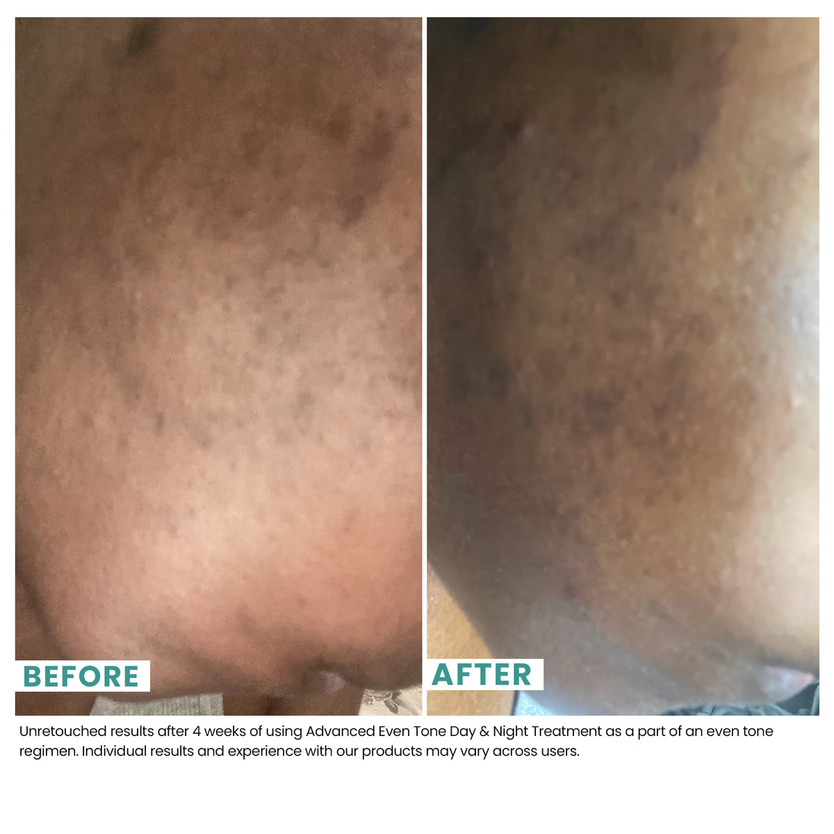 Comparison of woman's skin after four weeks of using USRx Advanced Even Tone Day & Night Treatment with visibly improved skin