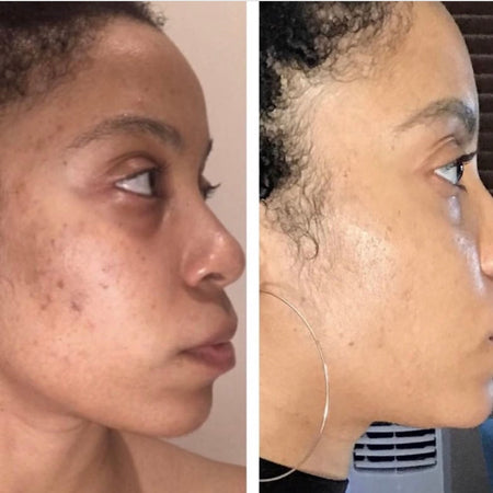 Before and after acne and hyperpgimentation results of African American Urban Skin Rx® customer with revitalized skin