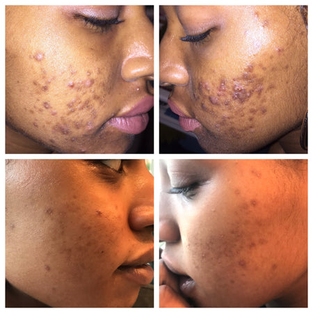 Before and after acne and hyperpgimentation results of African American Urban Skin Rx® customer with revitalized skin