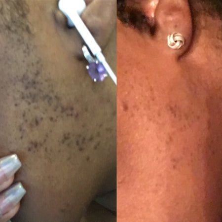Before and after hyperpigmentation results of African American Urban Skin Rx® customer