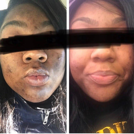 Before and after acne and hyperpgimentation results of African American Urban Skin Rx® customer with revitalized skin