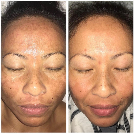 Before and after hyperpigmentation results of ethnically diverse Urban Skin Rx® customer