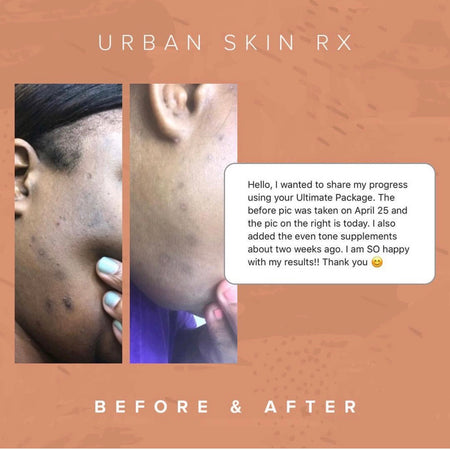 Before and after hyperpigmentation result of African American Urban Skin Rx® customer using the Ultimate Best Sellers Package