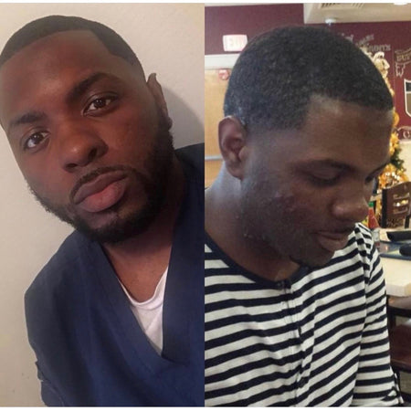 Before and after acne and hyperpgimentation results of African American male Urban Skin Rx® customer