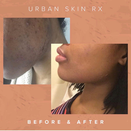 Before and after acne and hyperpgimentation results of African American Urban Skin Rx® customer