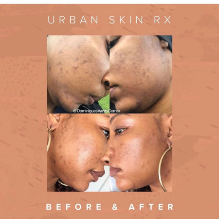 Before and after acne and hyperpgimentation results of African American Urban Skin Rx® customer