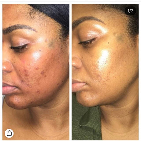 Before and after hyperpigmentation results of African American Urban Skin Rx® customer