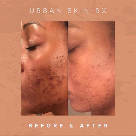 Before and after hyperpigmentation results of African American Urban Skin Rx® customer