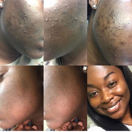 Before and after acne and hyperpgimentation results of African American Urban Skin Rx® customer with revitalized skin