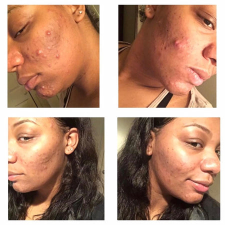 Before and after acne and hyperpgimentation results of African American Urban Skin Rx® customer