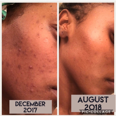 Before and after acne and hyperpgimentation results of African American Urban Skin Rx® customer