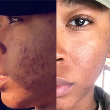 Before and after hyperpigmentation results of African American Urban Skin Rx® customer