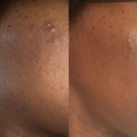 Before and after acne and hyperpgimentation results of African American Urban Skin Rx® customer with revitalized skin
