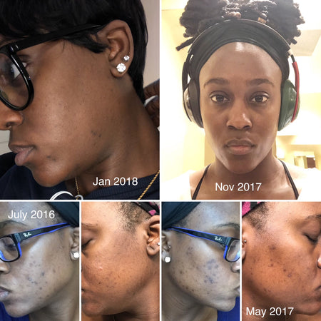 Before and after acne and hyperpgimentation results of African American Urban Skin Rx® customer with revitalized glowing skin