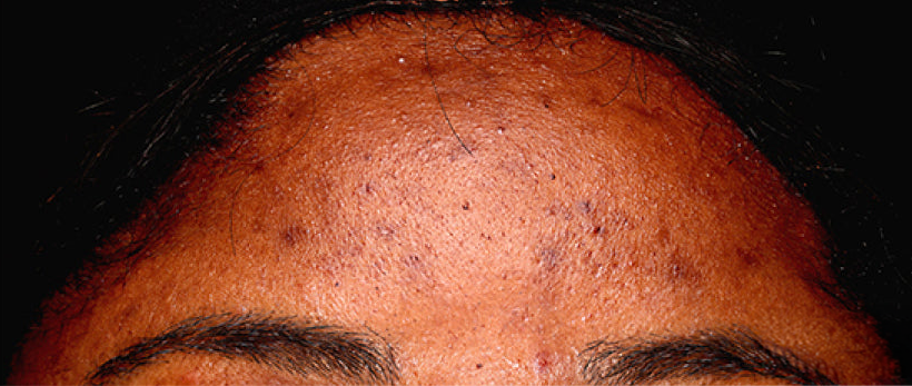 Woman's skin before using USRx HyperCorrect Intense Fading Cream