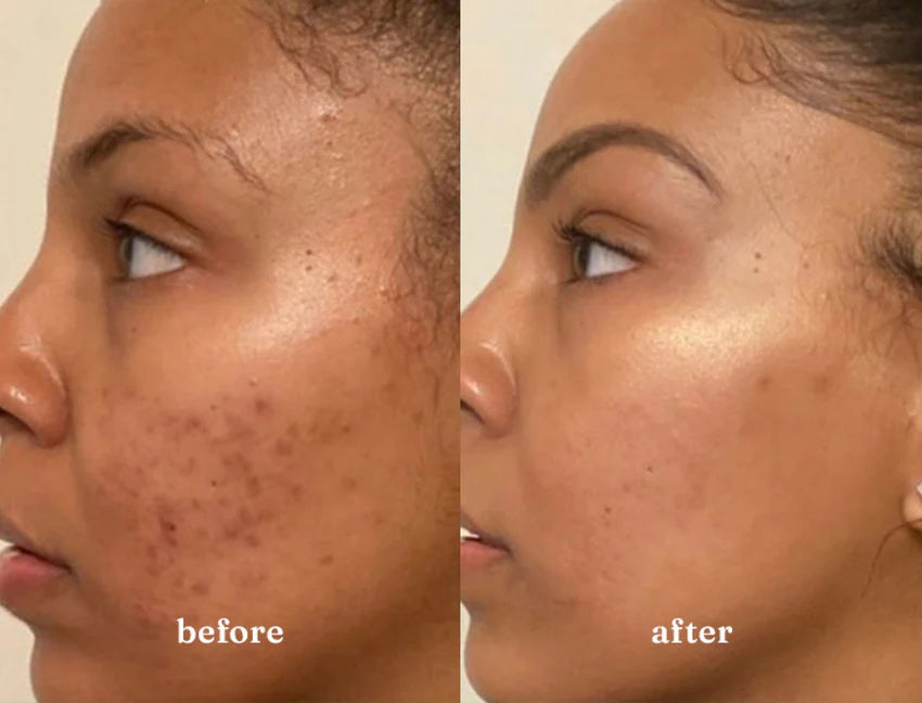 Woman's skin before and after using USRx Even Tone regimen