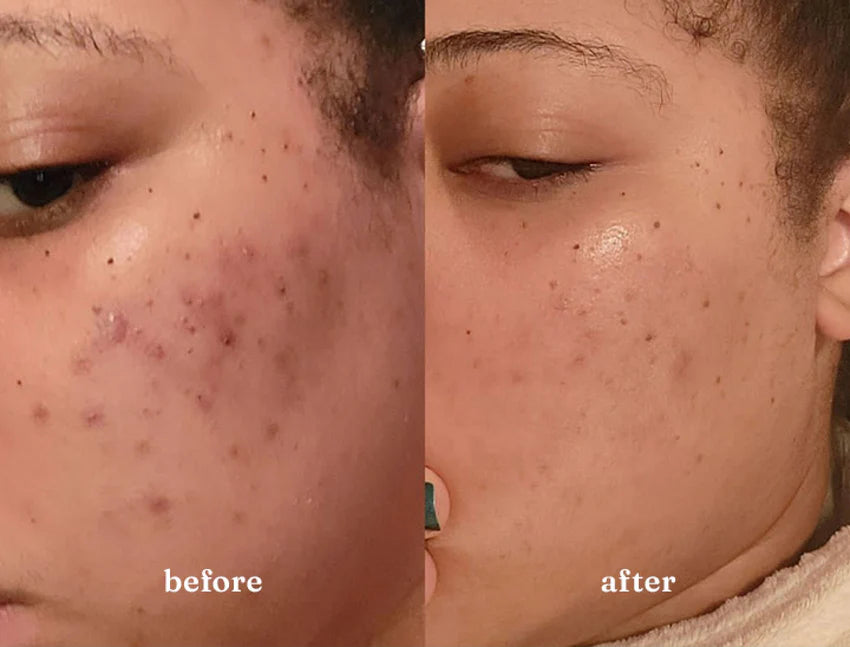 Woman's skin before and after using USRx Even Tone regimen