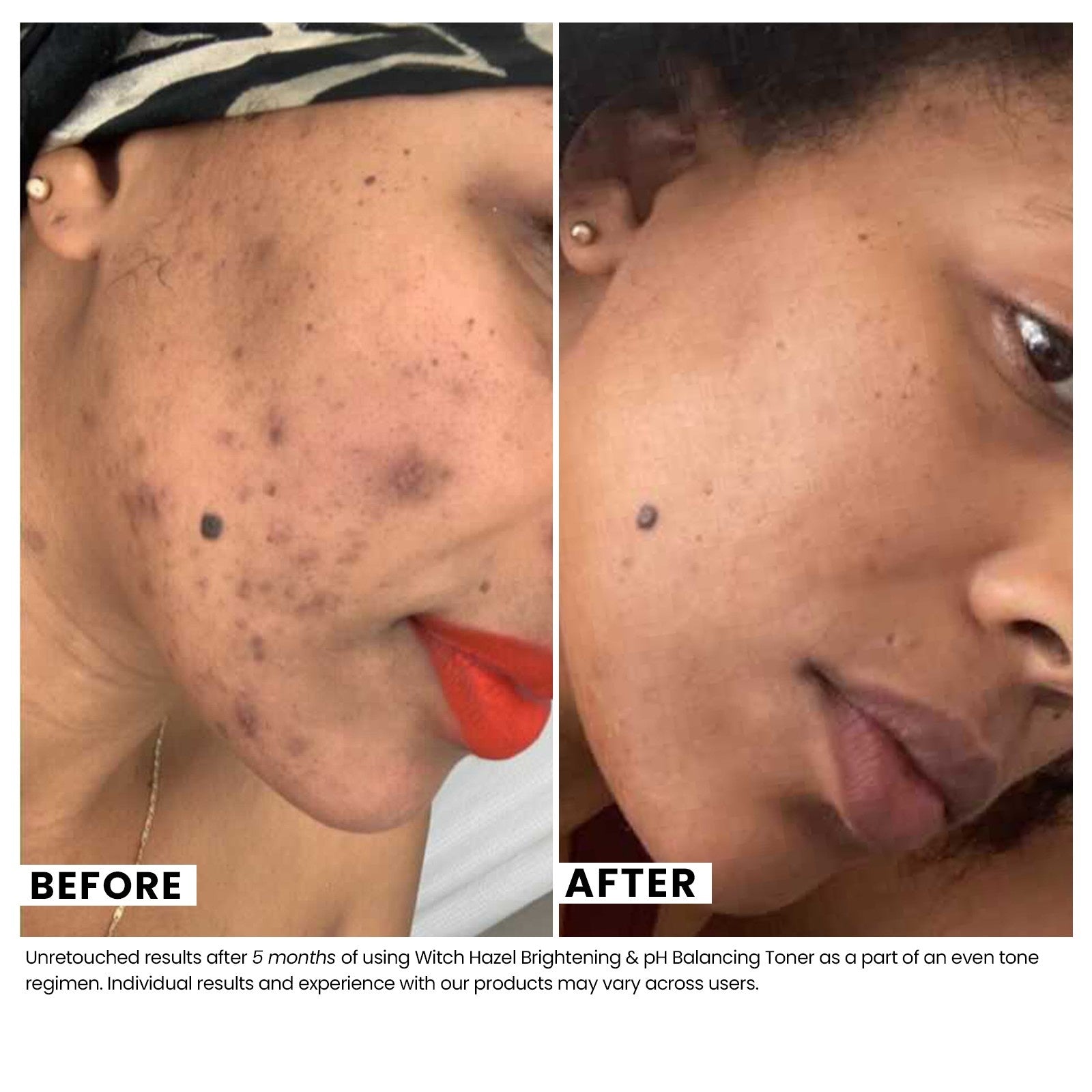 Woman's skin before and after using USRx even tone regimen